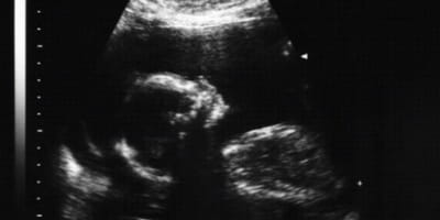"I Feel Super Great About Having an Abortion" — The Culture of Death Goes Viral