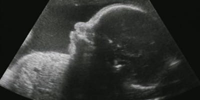 Does the ALS Ice Bucket Challenge Kill Babies?