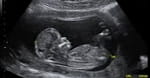 Millennials Meet Ultrasounds: The Conscience, Technology, and New Life
