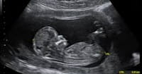 Abortion Rate at Lowest Since Roe vs. Wade