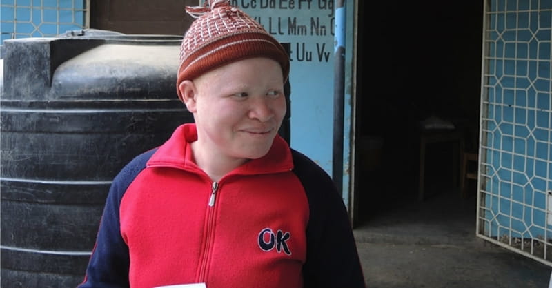 Illegal Trade in Body Parts Threatens Africans with Albinism