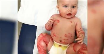 Mother Kisses Ridiculed Baby With Skin Disease